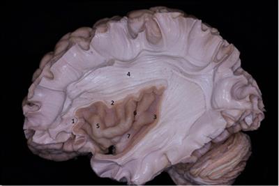Avoiding vascular complications in insular <mark class="highlighted">glioma surgery</mark> – A microsurgical anatomy study and critical reflections regarding intraoperative findings